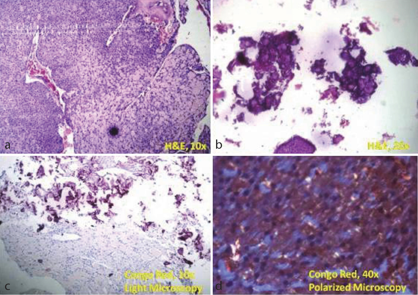 calcifying odontogenic cyst histopathology