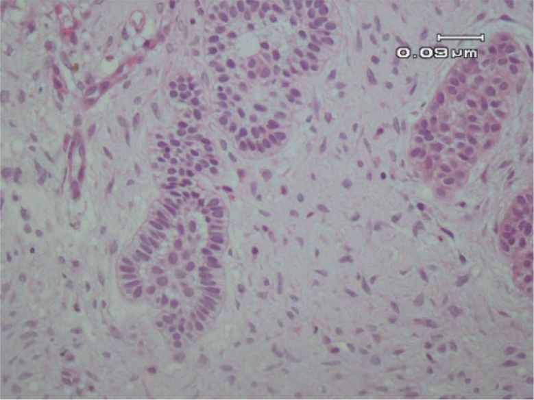 calcifying odontogenic cyst histopathology