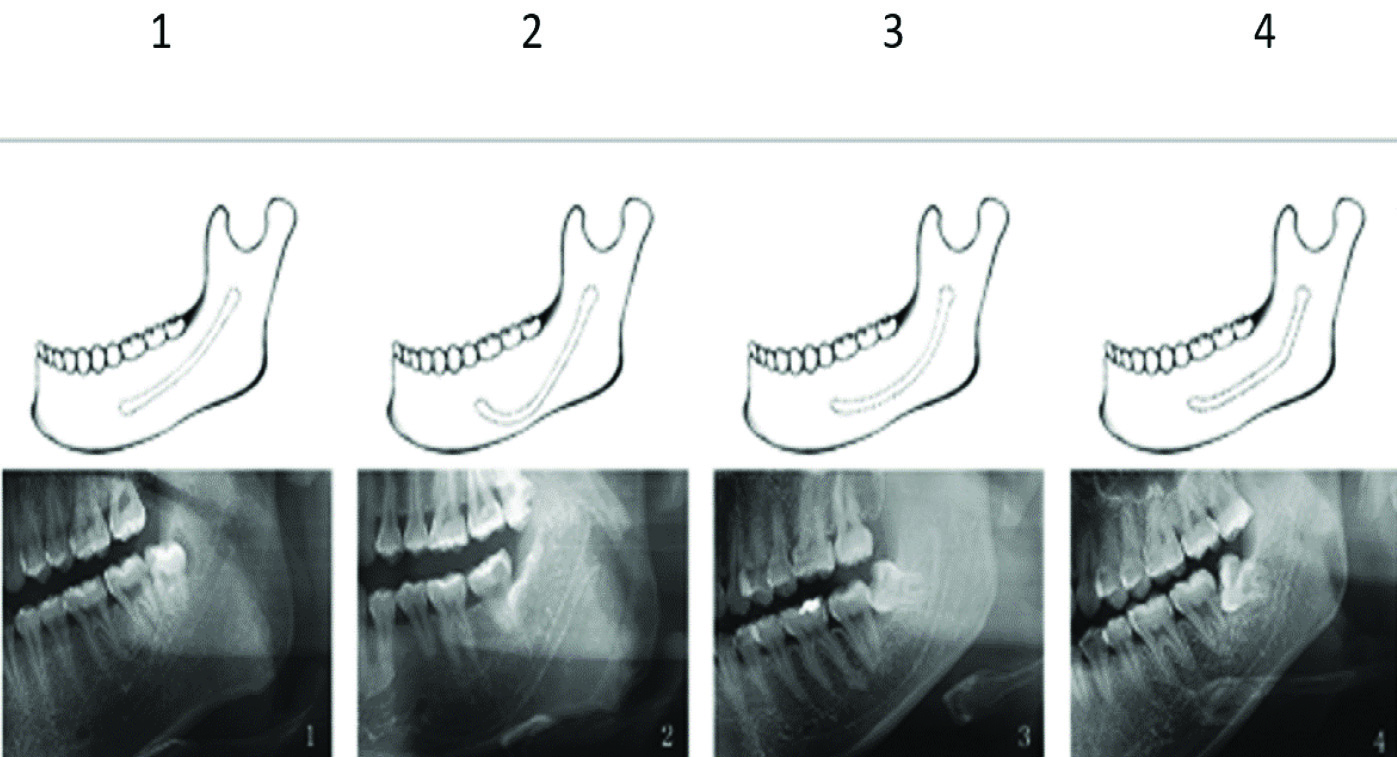 inferior alveolar nerve canal