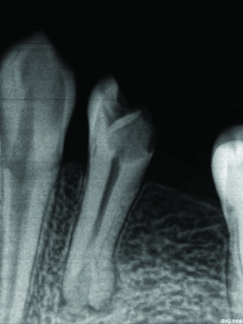 Endodontic Management of a Two-rooted Mandibular First Endodontic Management of a Two-rooted Mandibular First