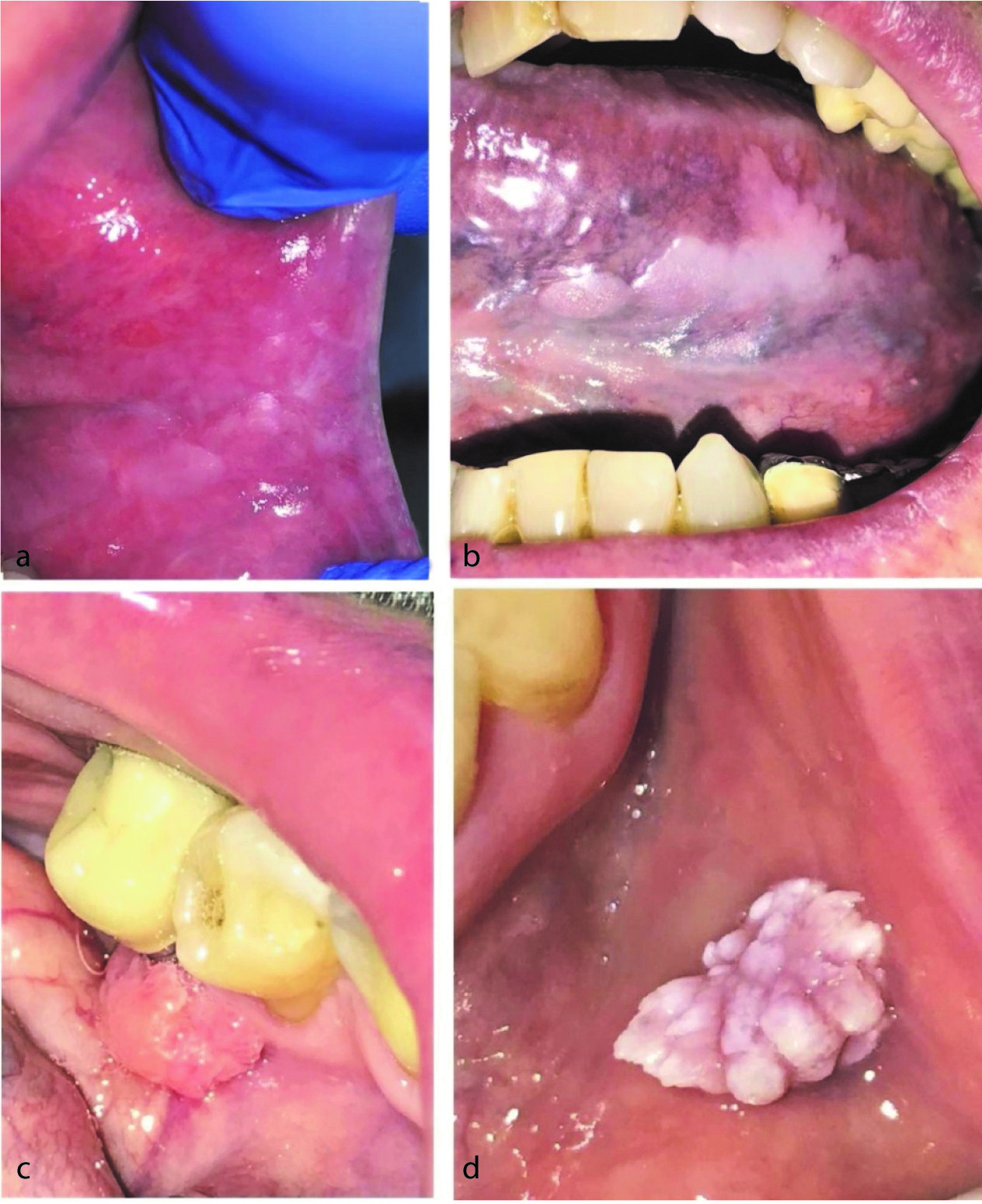 ventral buccal mucosa tongue