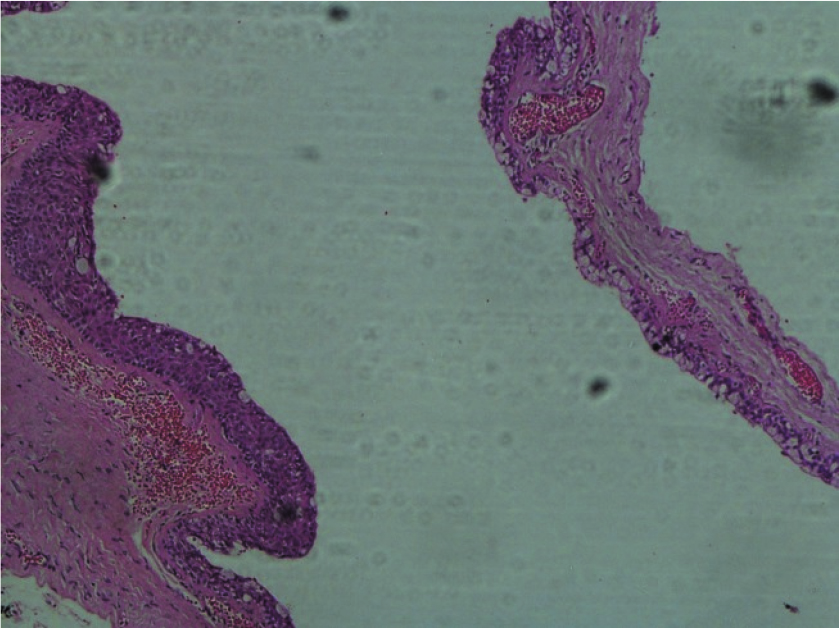 nasolabial cyst histology