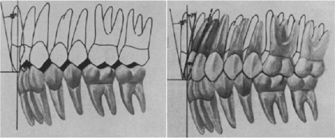 PDF) Mesiodistal angulation of the lateral teeth to the functional occlusal  plane in normal occlusions