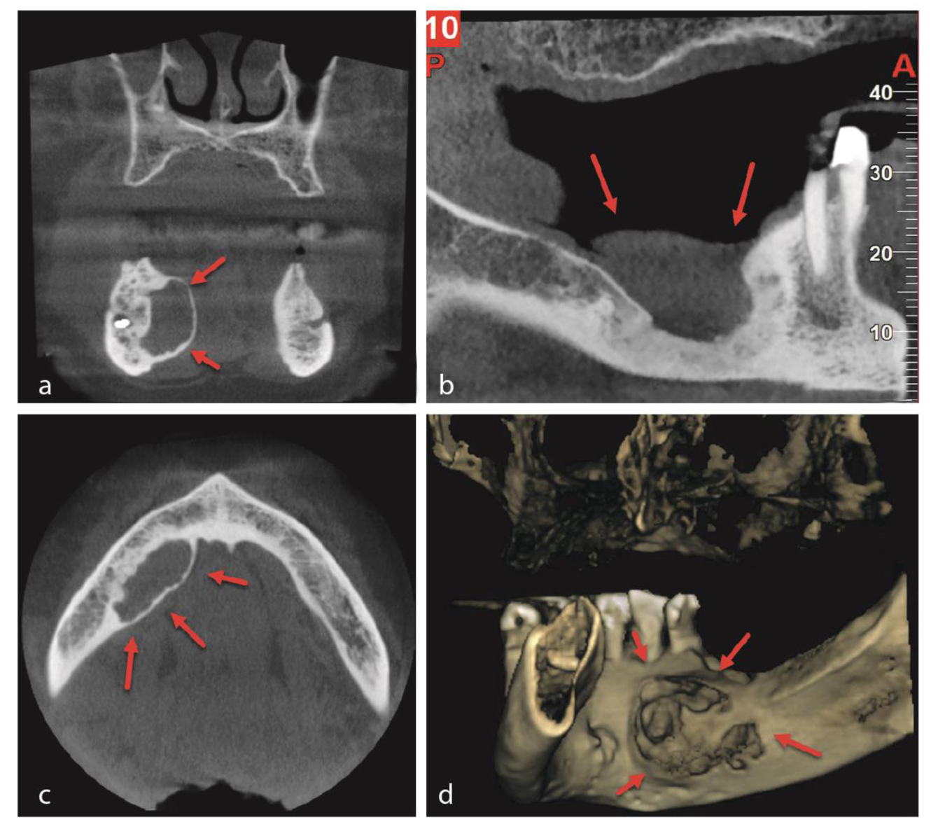 multiple myeloma mandible