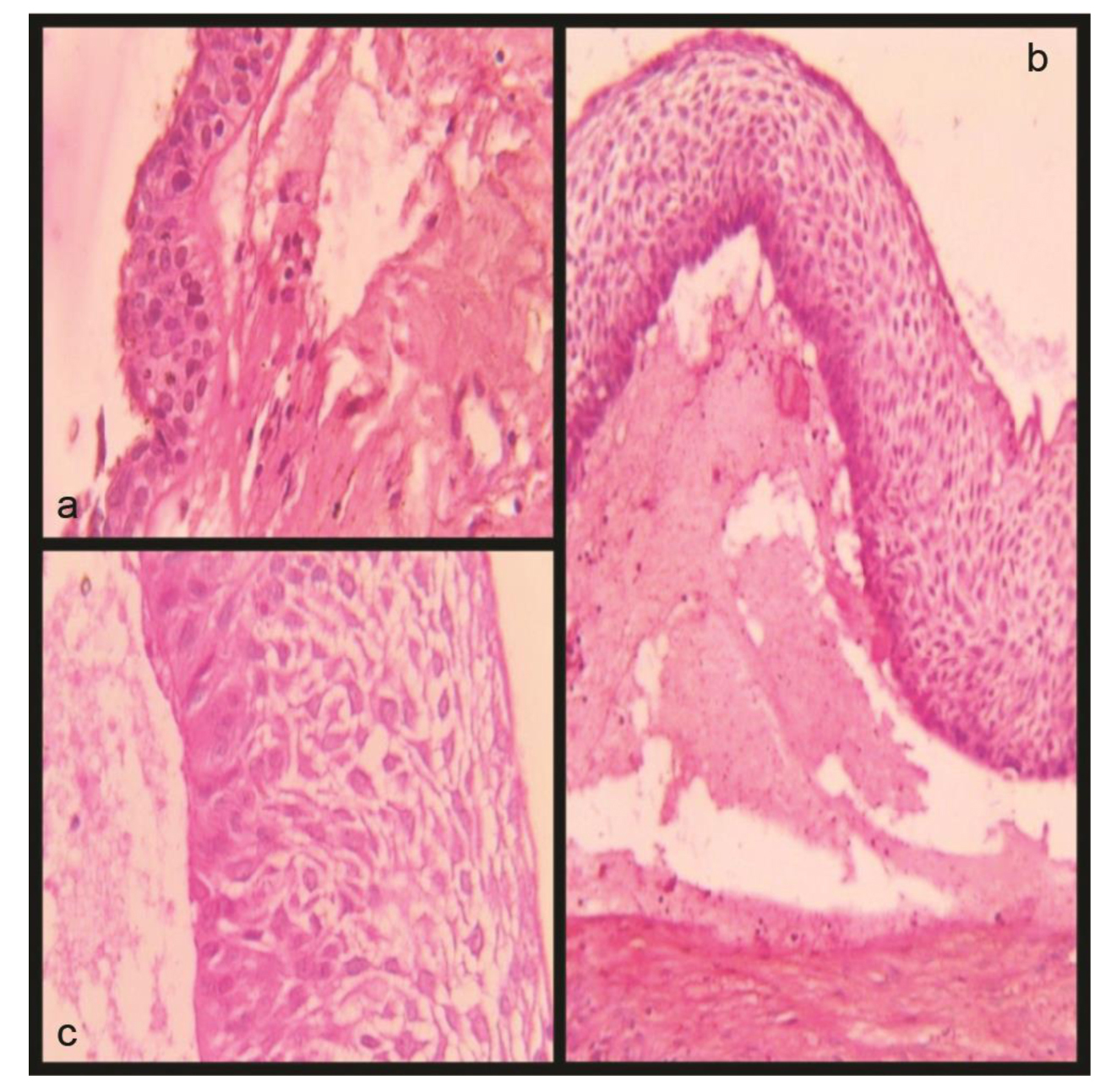 Conservative Management of Unicystic Ameloblastoma of Mandible Evolving  from Dentigerous Cyst in a Paediatric Patient: A Case Report