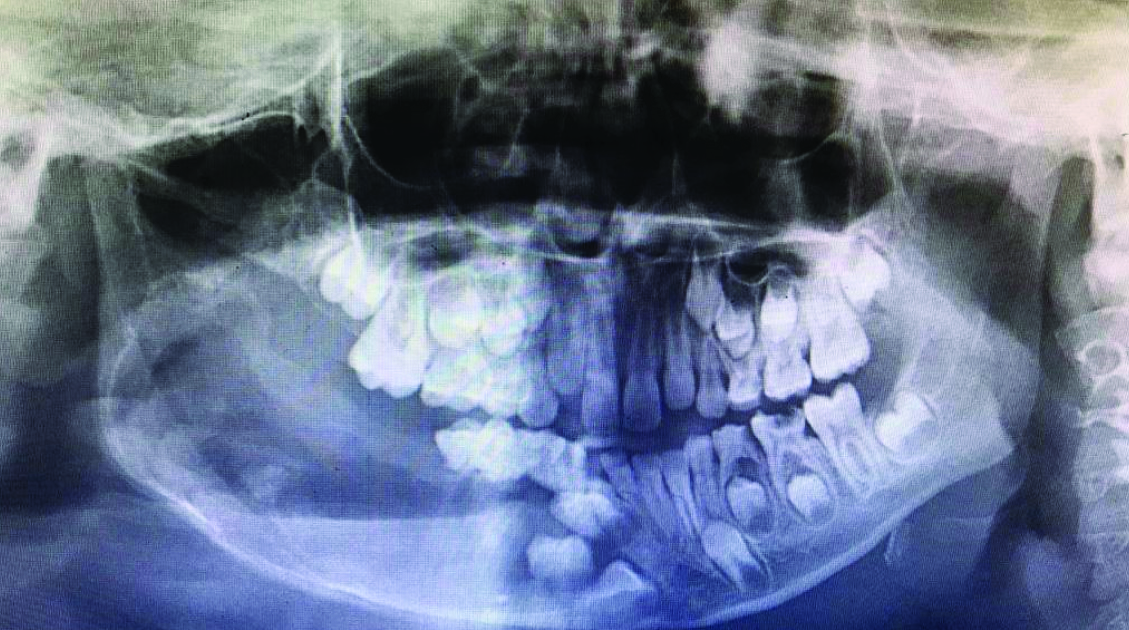 a: Cystic lumen lined by stratified squamous non-keratinized