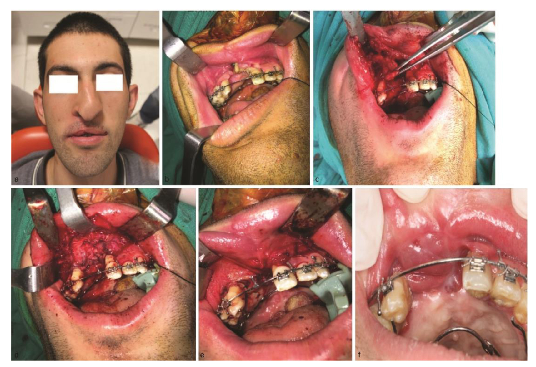 Cleft Palate Repair with Orbicularis Oris Plus Buccal Mucosal Flap