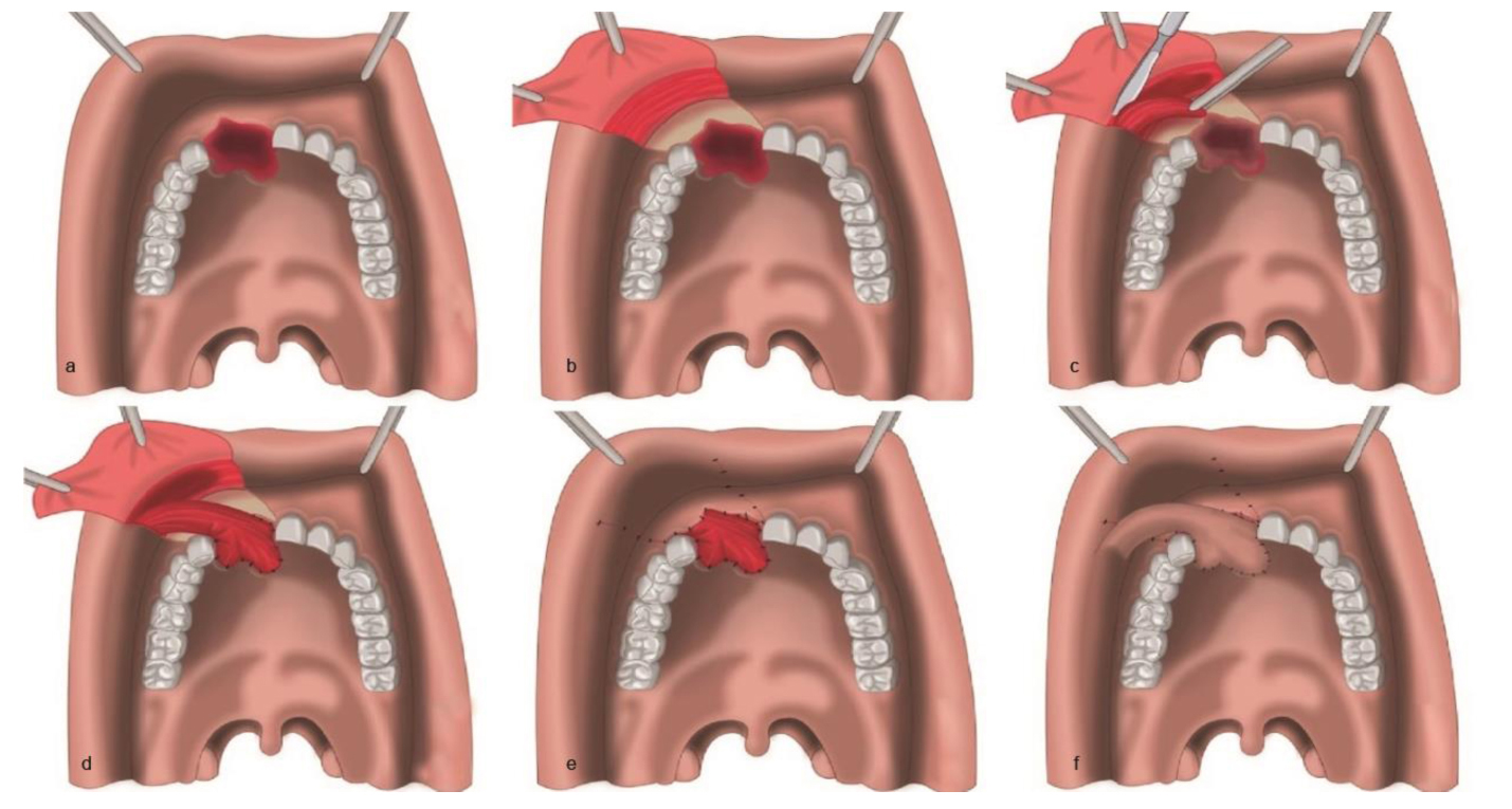 Cleft Palate Repair with Orbicularis Oris Plus Buccal Mucosal Flap